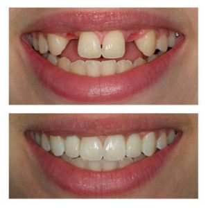Before and after closeup of a smile that was enhanced through dental implants.