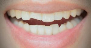 Smile of a patient with a chipped tooth