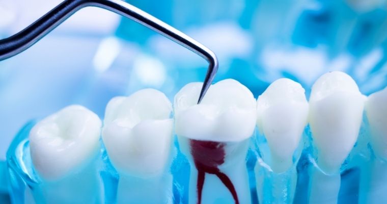 10 FAQs About Root Canals [VIDEO]