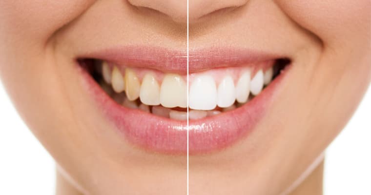 A smile split in half with one side showing before teeth whitening and the other side showing after