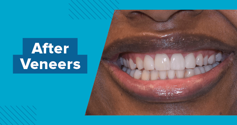 Can You Tell If Your Front Teeth Have Veneers?