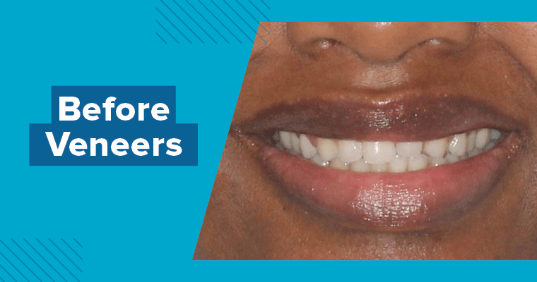 A patient's smile before veneers on their front teeth