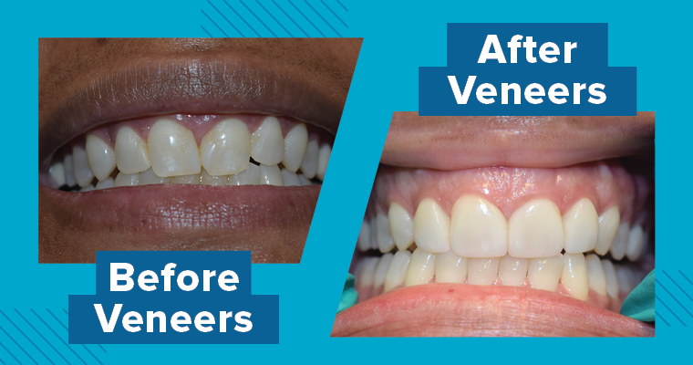 Side by side comparison of before and after veneers