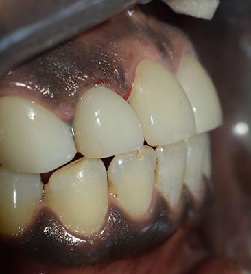 Gap in teeth repaired with a bridge