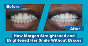 A before and after smile makeover with veneers and bridges